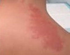 ポートワイン母斑